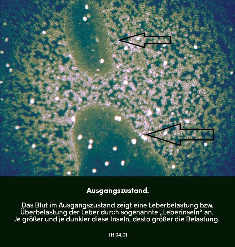 Dunkelfeldmikroskopie Testreihe 03: Ausgangszustand – Blutprobe mit deutlich erkennbaren „Leberinseln“ (Hinweis auf Leberbelastung), markiert durch Pfeile.