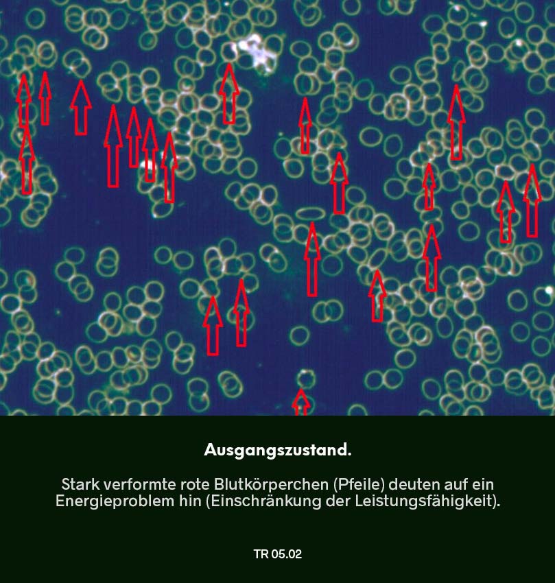 Dunkelfeldmikroskopie Testreihe 04:  Ausgangszustand – Blutprobe mit starken Verklumpungen und deutlich eingeschränkter Beweglichkeit der roten Blutkörperchen (Hinweis auf Energieproblem).