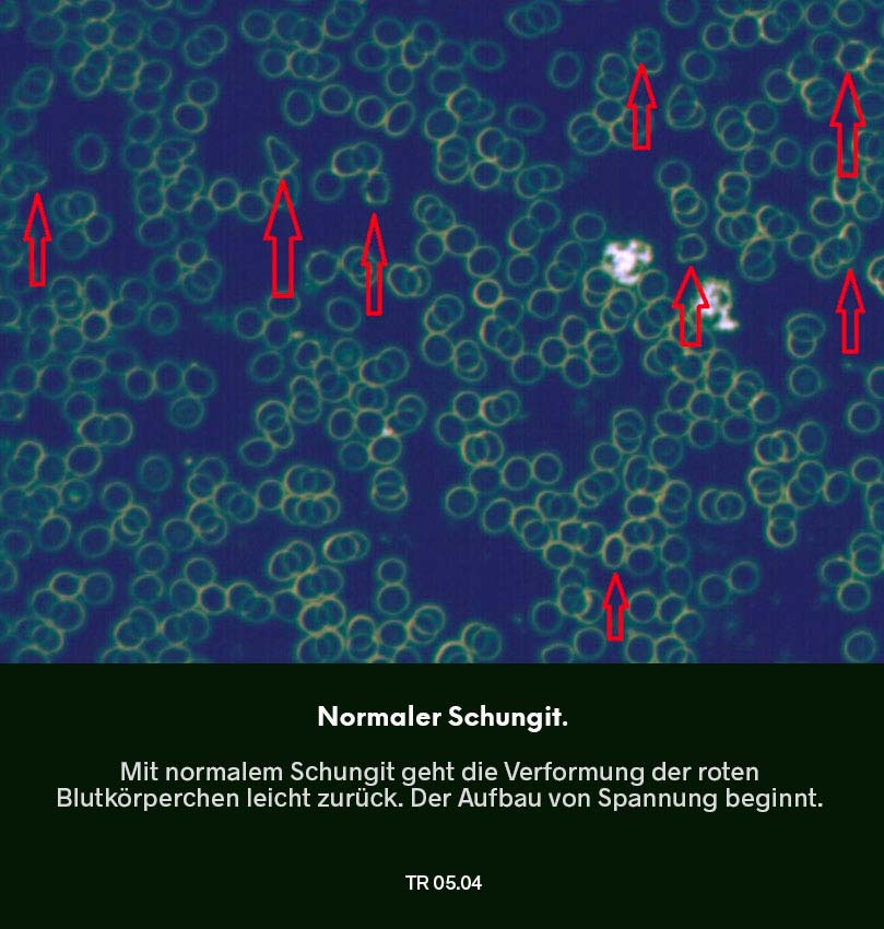 Dunkelfeldmikroskopie Testreihe 04: Blutprobe nach Nutzung von normalem Schungit – Verklumpungen der roten Blutkörperchen gehen leicht reduziert, markierter Bereich im Bild.