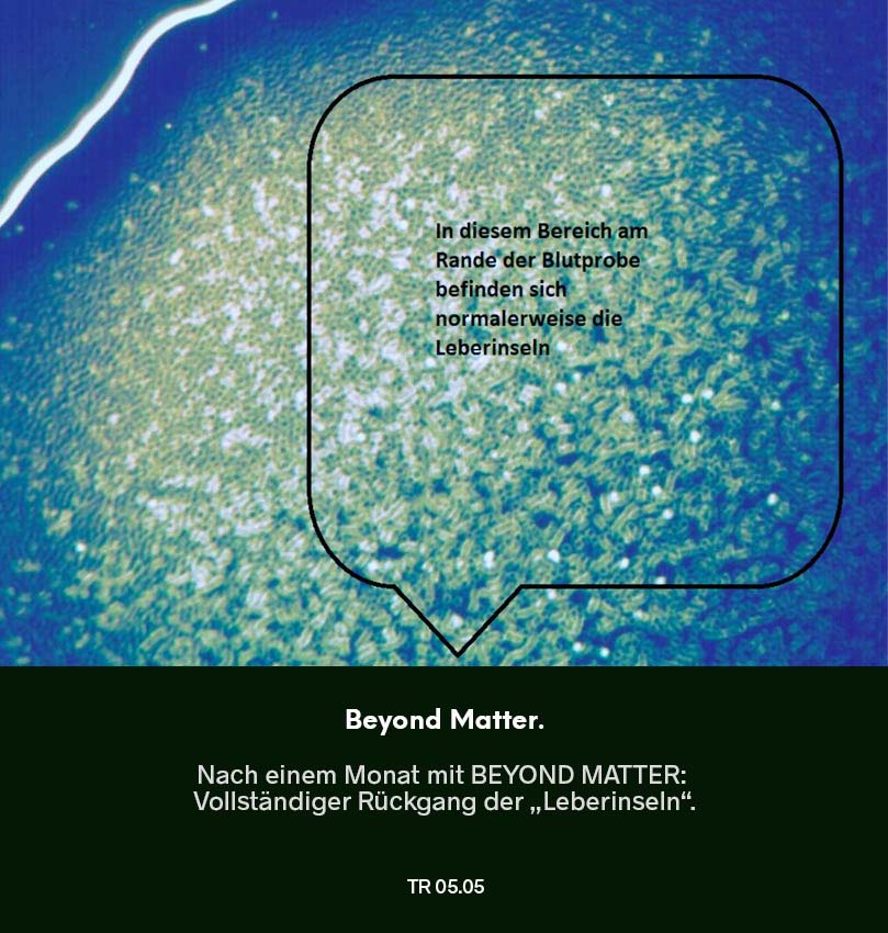 Dunkelfeldmikroskopie Testreihe 04: Blutprobe nach Nutzung von Beyond Matter – vollständiger Rückgang der „Leberinseln“ (Hinweis auf Leberbelastung), markierter Bereich im Bild.