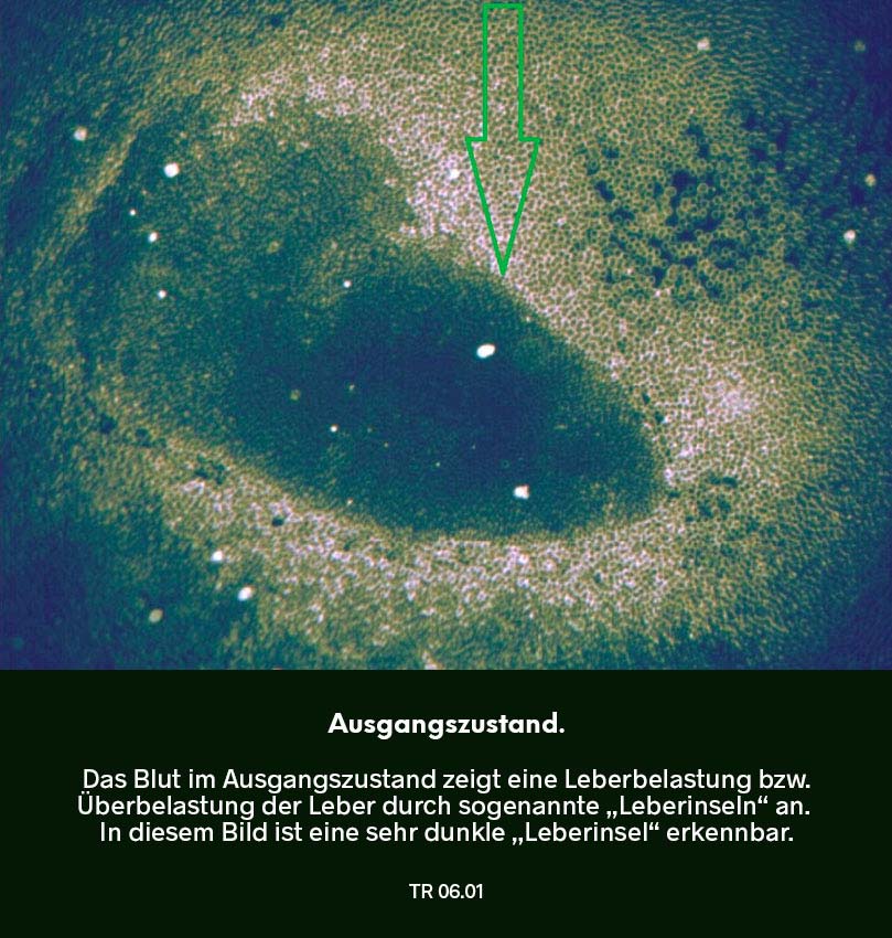 Dunkelfeldmikroskopie Testreihe 05: Ausgangszustand – Blutprobe mit deutlich erkennbaren „Leberinseln“ (Hinweis auf Leberbelastung), markiert durch Pfeil.